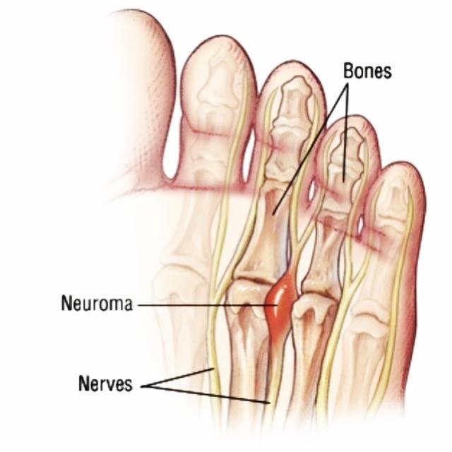 Morton's Neuroma - Toe Pain - OnePoint Podiatry - Penrith