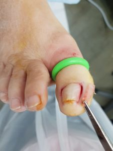 Ingrown toenail