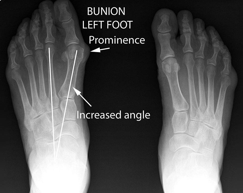 bunion xray