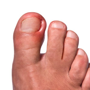 Treat an ingrown nail